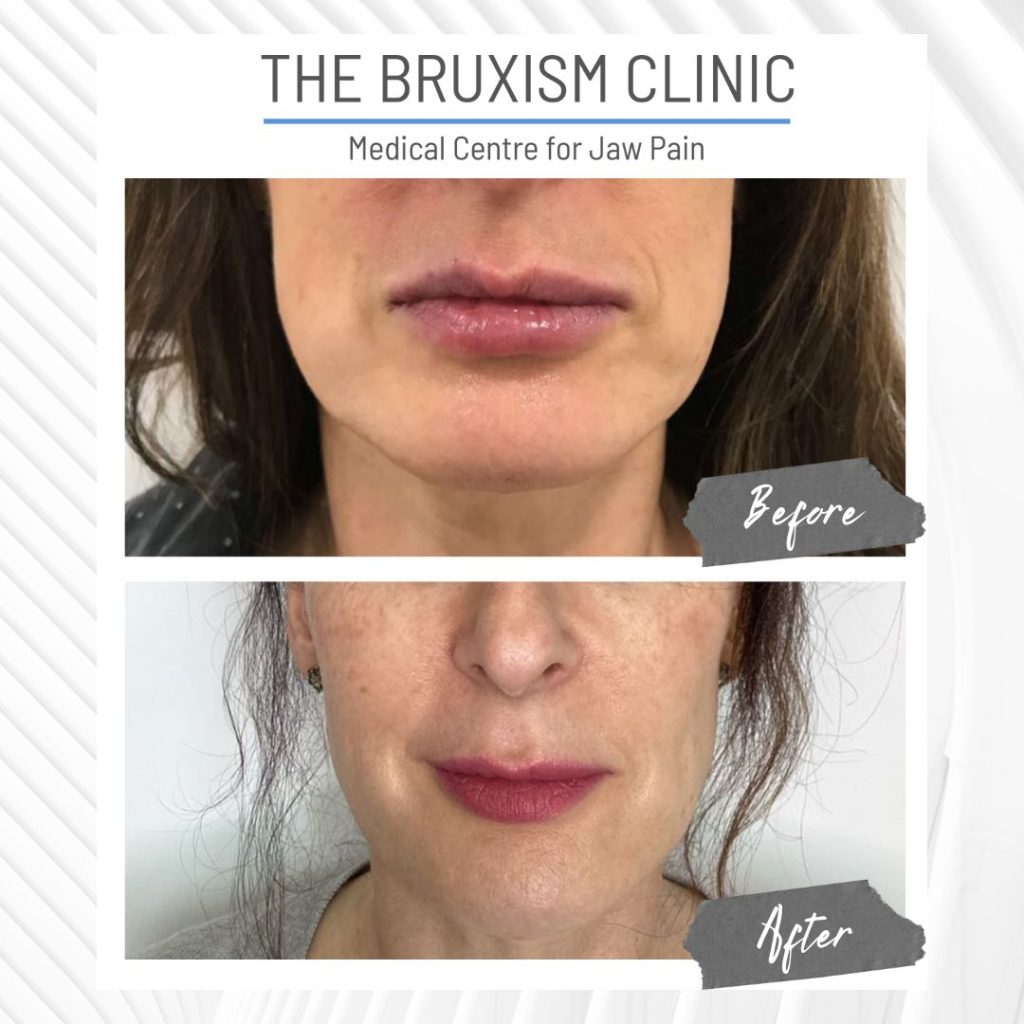 TBC Before and After 1