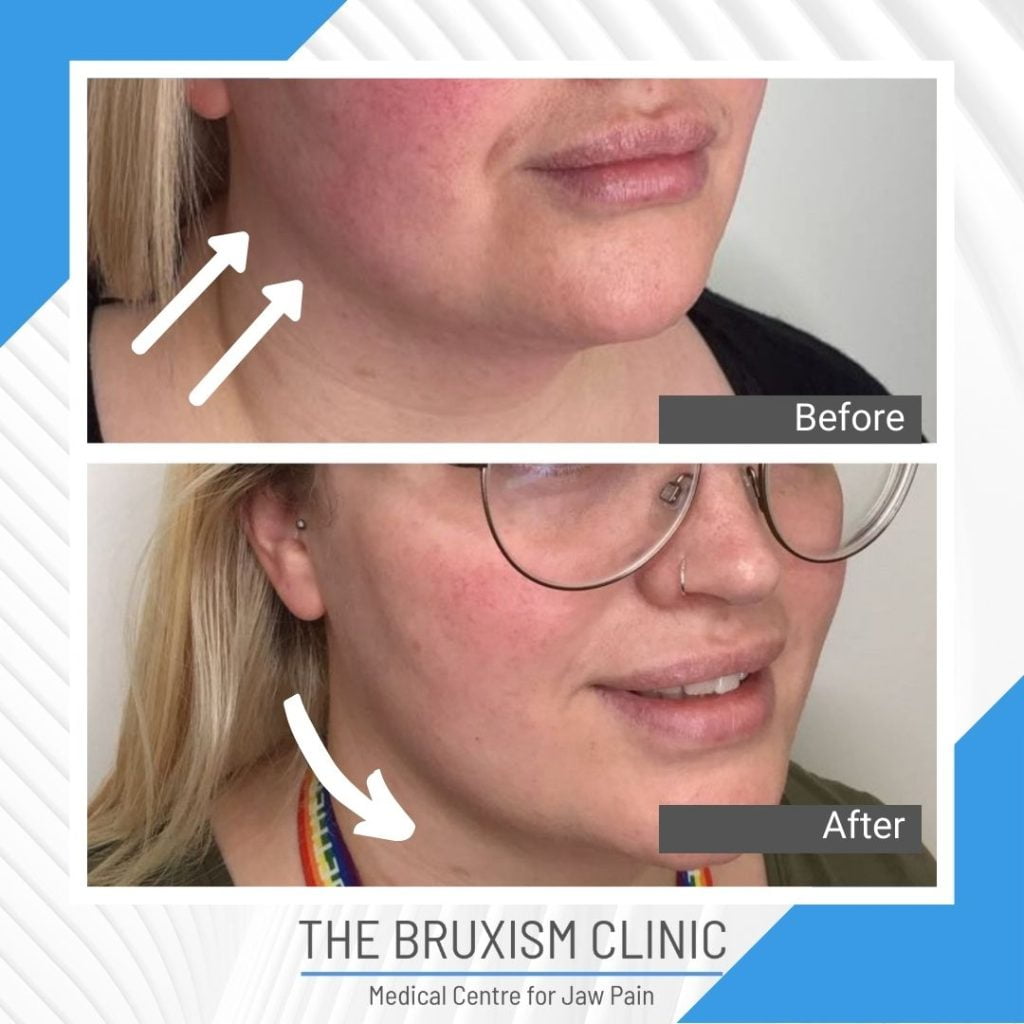 TBC Before and After442